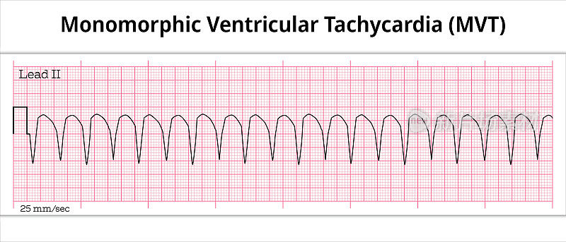 Monomorphic Ventricular Tachycardia (PVT) ECG – Monomorphic VT - 8 Second Electrocardiography Paper